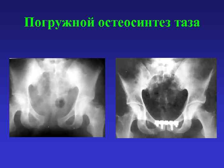 Погружной остеосинтез таза 