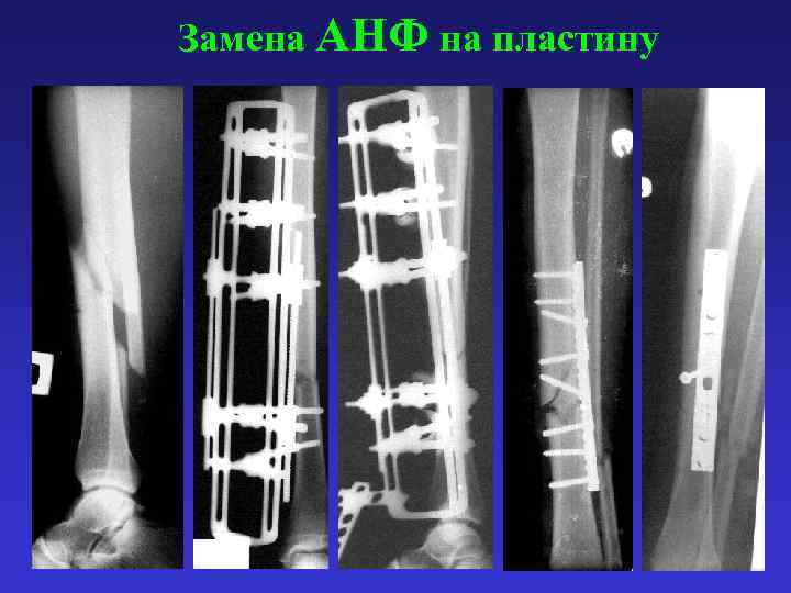 Замена АНФ на пластину 