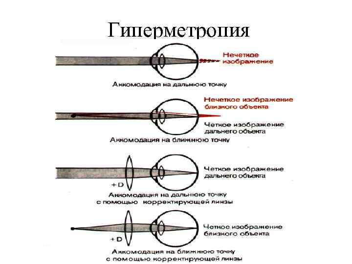 Гиперметропия 1 степени глаз