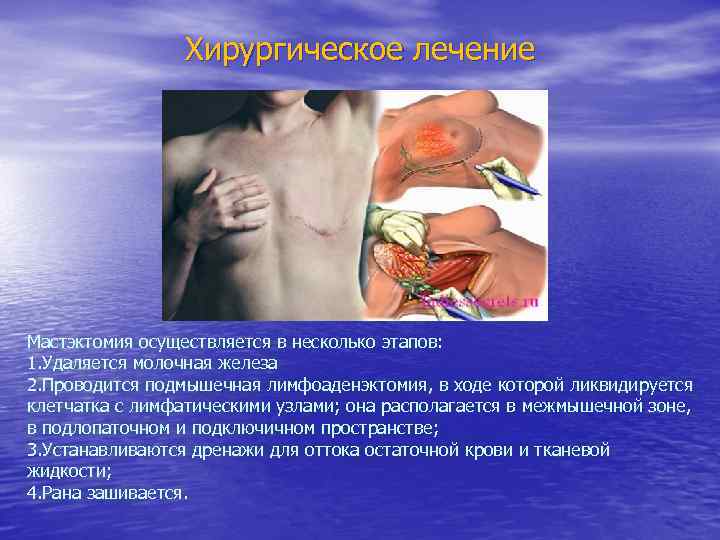 Хирургическое лечение Мастэктомия осуществляется в несколько этапов: 1. Удаляется молочная железа 2. Проводится подмышечная