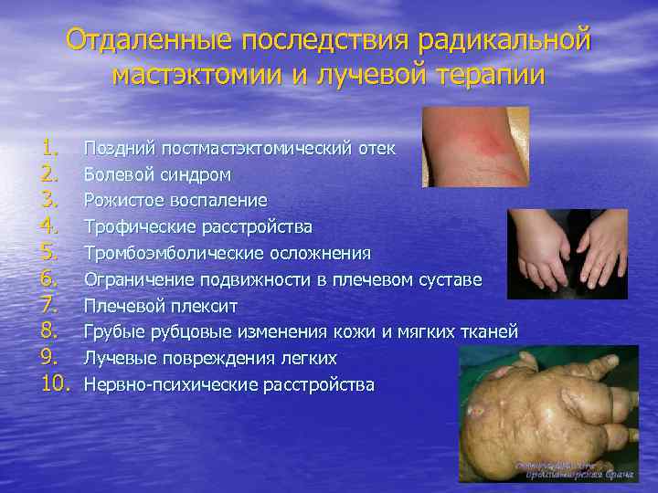 Отдаленные последствия радикальной мастэктомии и лучевой терапии 1. 2. 3. 4. 5. 6. 7.