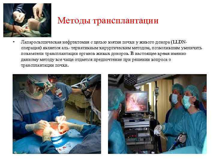 Методы трансплантации • Лапароскопическая нефрэктомия с целью взятия почки у живого донора (LLDNоперация) является