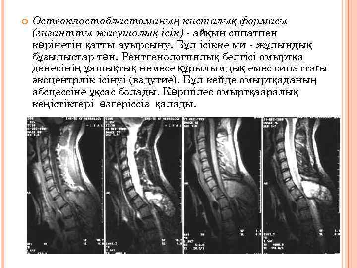  Остеокластобластоманың кисталық формасы (гигантты жасушалық ісік) - айқын сипатпен көрінетін қатты ауырсыну. Бұл