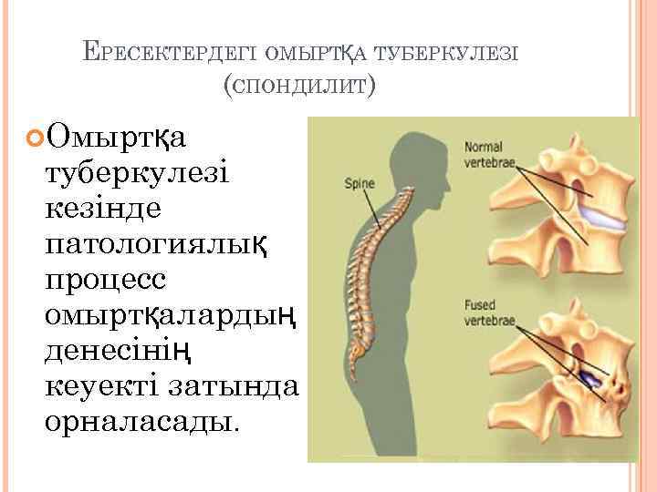 ЕРЕСЕКТЕРДЕГІ ОМЫРТҚА ТУБЕРКУЛЕЗІ (СПОНДИЛИТ) Омыртқа туберкулезі кезінде патологиялық процесс омыртқалардың денесінің кеуекті затында орналасады.