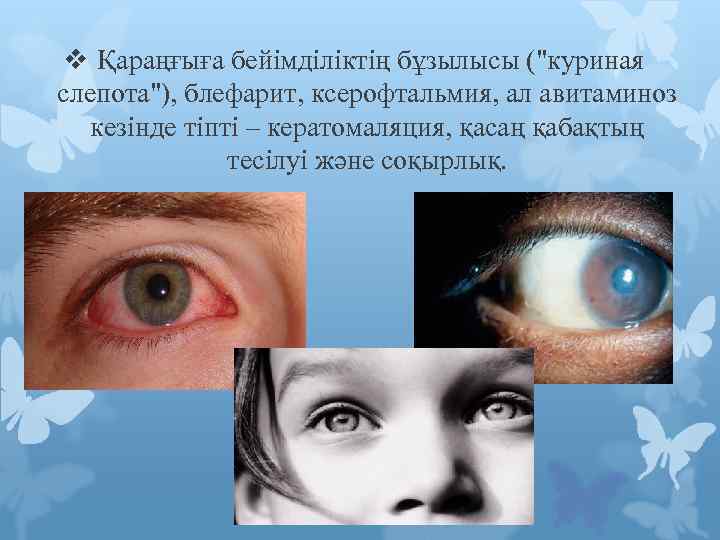 v Қараңғыға бейімділіктің бұзылысы ("куриная слепота"), блефарит, ксерофтальмия, ал авитаминоз кезінде тіпті – кератомаляция,