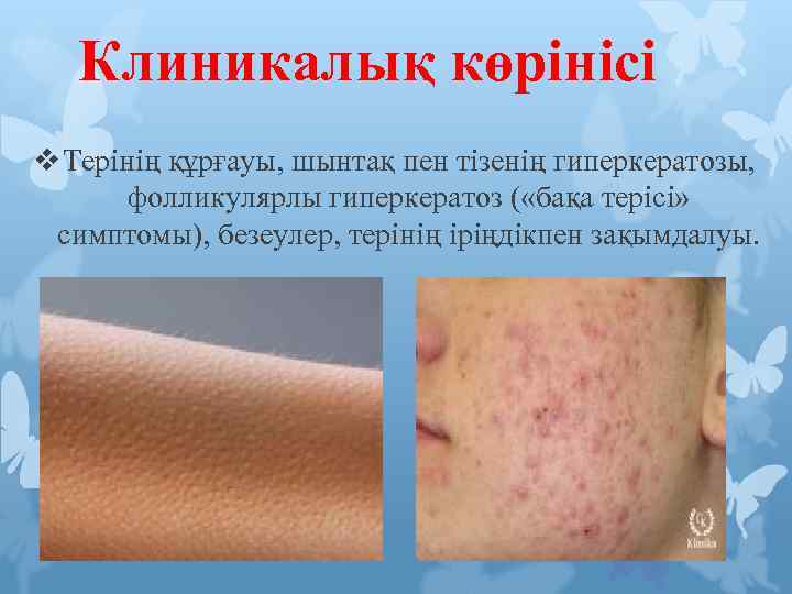 Клиникалық көрінісі v Терінің құрғауы, шынтақ пен тізенің гиперкератозы, фолликулярлы гиперкератоз ( «бақа терісі»