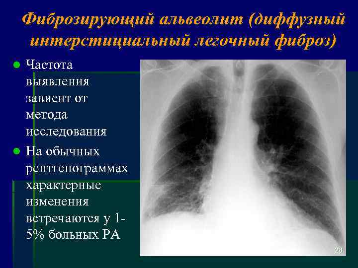 Фиброзирующий альвеолит (диффузный интерстициальный легочный фиброз) Частота выявления зависит от метода исследования l На