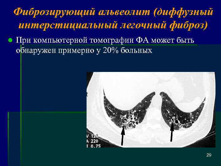 Фиброзирующий альвеолит (диффузный интерстициальный легочный фиброз) l При компьютерной томографии ФА может быть обнаружен