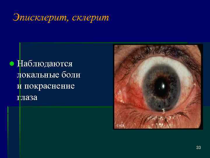 Эписклерит, склерит l Наблюдаются локальные боли и покраснение глаза 33 