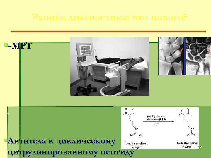 Ранняя диагностика: что нового? §-МРТ §Антитела к циклическому цитрулинированному пептиду 57 