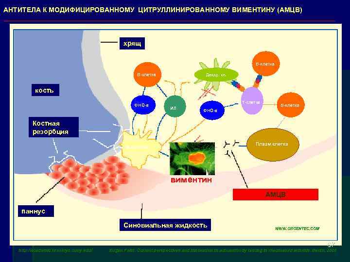 АНТИТЕЛА К МОДИФИЦИРОВАННОМУ ЦИТРУЛЛИНИРОВАННОМУ ВИМЕНТИНУ (АМЦВ) хрящ B клетка Дендр. кл. кость ФНО а