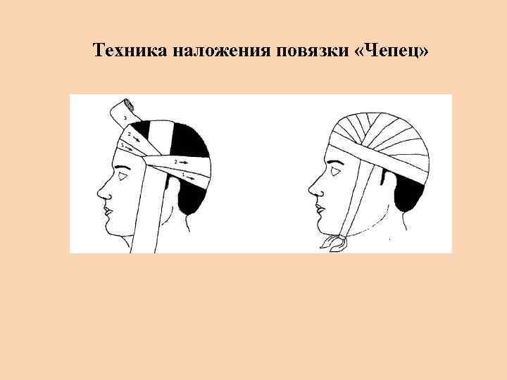 Техника наложения повязки чепец. Повязка чепец техника. Схема наложения повязки чепец. Десмургия повязка чепец. Алгоритм наложения повязки чепец на голову.