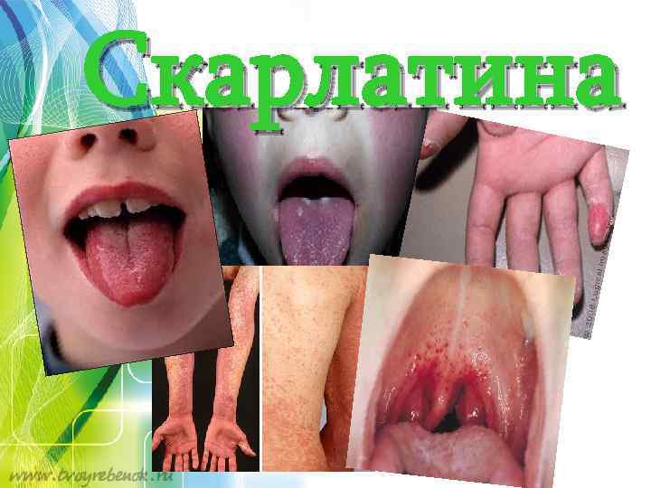 Скарлатина 