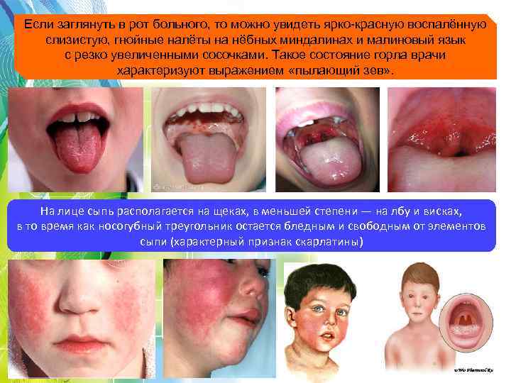 Если заглянуть в рот больного, то можно увидеть ярко-красную воспалённую слизистую, гнойные налёты на