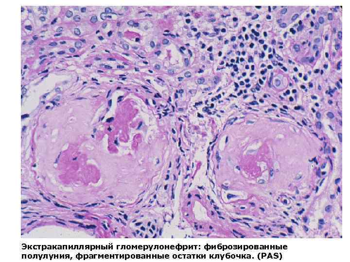 Экстракапиллярный гломерулонефрит: фиброзированные полулуния, фрагментированные остатки клубочка. (PAS) 