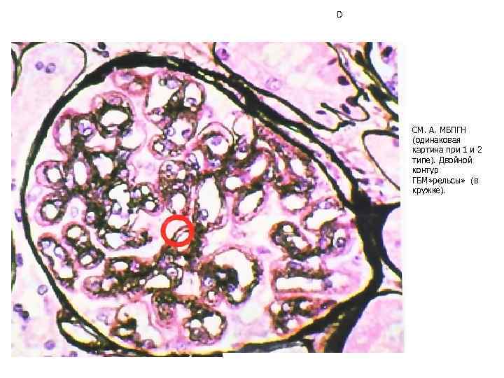 D СМ. А. МБПГН (одинаковая картина при 1 и 2 типе). Двойной контур ГБМ»
