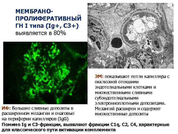 МЕМБРАНОПРОЛИФЕРАТИВНЫЙ ГН I типа (Ig+, C 3+) выявляется в 80% ЭМ: показывают петли капилляра