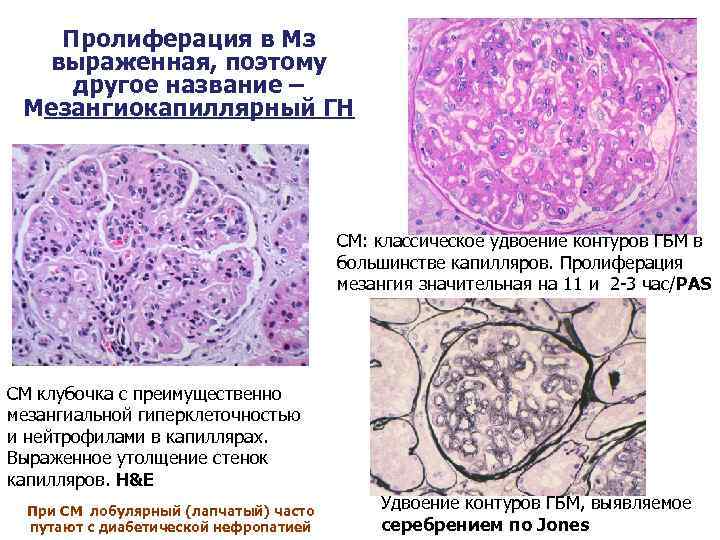 Пролиферация в Мз выраженная, поэтому другое название – Мезангиокапиллярный ГН СМ: классическое удвоение контуров