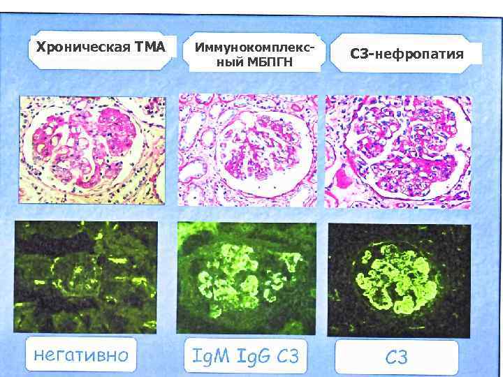 Хроническая ТМА Иммунокомплексный МБПГН С 3 -нефропатия 