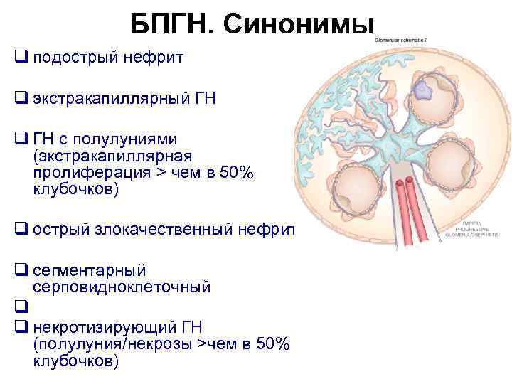 БПГН. Синонимы q подострый нефрит q экстракапиллярный ГН q ГН с полулуниями (экстракапиллярная пролиферация