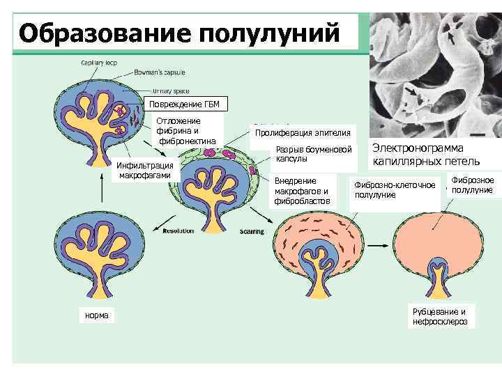 Образование полулуний Повреждение ГБМ Отложение фибрина и фибронектина Инфильтрация макрофагами норма Пролиферация эпителия Разрыв