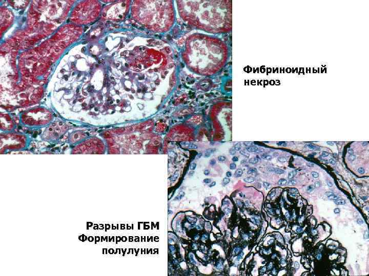 Фибриноидный некроз Разрывы ГБМ Формирование полулуния 