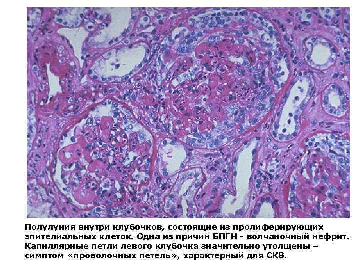 Полулуния внутри клубочков, состоящие из пролиферирующих эпителиальных клеток. Одна из причин БПГН - волчаночный