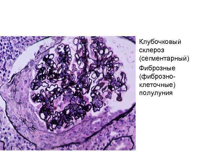  • Клубочковый склероз (сегментарный) • Фиброзные (фиброзноклеточные) полулуния 