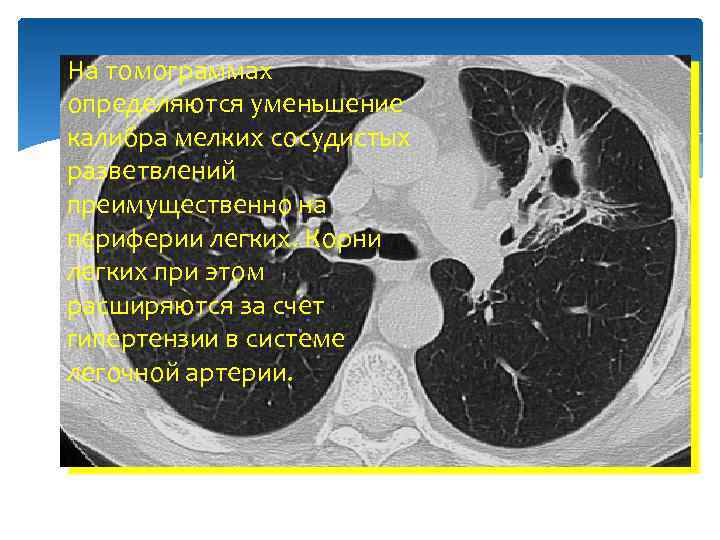 Ha томограммах определяются уменьшение калибра мелких сосудистых разветвлений преимущественно на периферии легких. Корни легких