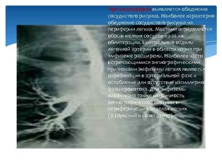 При ангиографии выявляется обеднение сосудистого рисунка. Наиболее характерно обеднение сосудистого рисунка на периферии легких.