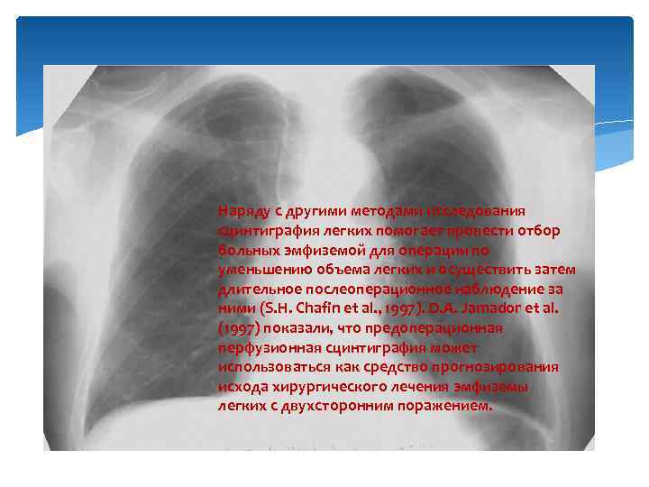 Наряду с другими методами исследования сцинтиграфия легких помогает провести отбор больных эмфиземой для операции