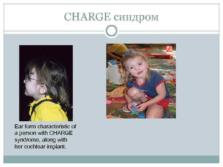 CHARGE синдром Ear form characteristic of a person with CHARGE syndrome, along with her