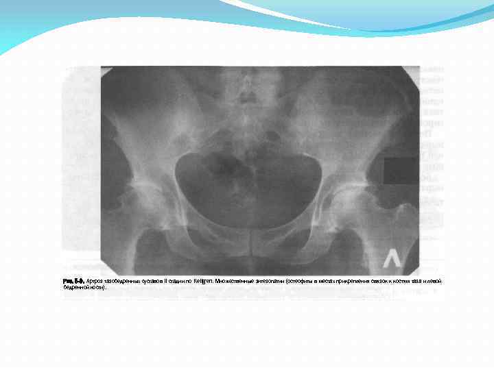 Рис. 5 -9. Артроз тазобедренных суставов II стадии по Kellgren. Множественные энтезопатии (остеофиты в