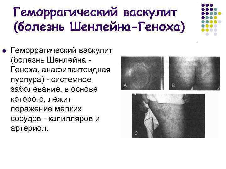 Геморрагический васкулит (болезнь Шенлейна-Геноха) l Геморрагический васкулит (болезнь Шенлейна Геноха, анафилактоидная пурпура) системное заболевание,