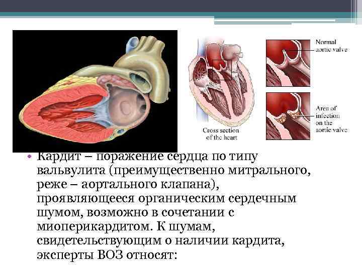 Ревмокардит. Ревматический эндокардит(вальвулит). Поражение сердца при ревматизме.