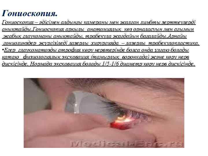 Гониоскопия. Гониоскопия – әдісімен алдынғы камераны мен жалған лимбты зерттеулерді анықтайды. Гониоскопия арқылы анатомиялық