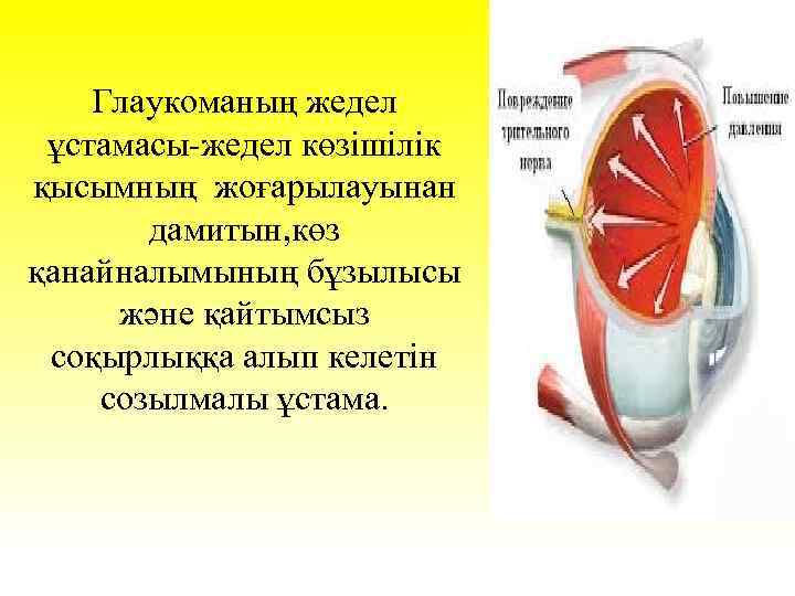 Глаукоманың жедел ұстамасы-жедел көзішілік қысымның жоғарылауынан дамитын, көз қанайналымының бұзылысы және қайтымсыз соқырлыққа алып
