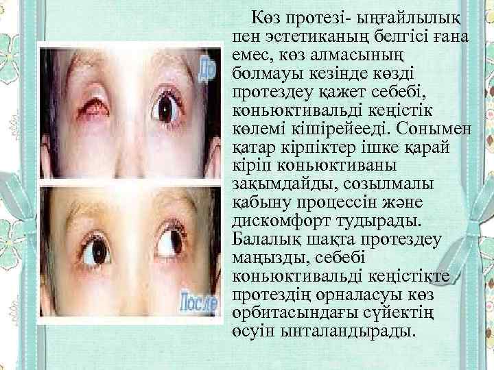  Көз протезі- ыңғайлылық пен эстетиканың белгісі ғана емес, көз алмасының болмауы кезінде көзді