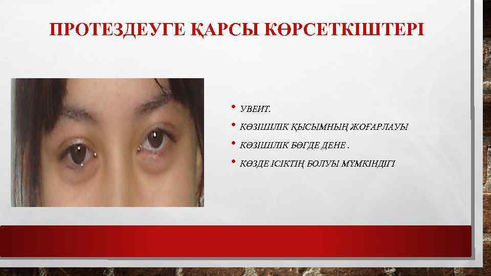 ПРОТЕЗДЕУГЕ ҚАРСЫ КӨРСЕТКІШТЕРІ • УВЕИТ. • КӨЗІШІЛІК ҚЫСЫМНЫҢ ЖОҒАРЛАУЫ • КӨЗІШІЛІК БӨГДЕ ДЕНЕ. •