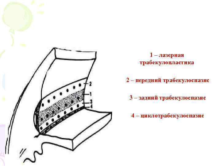 1 – лазерная трабекулопластика 2 – передний трабекулоспазис 3 – задний трабекулоспазис 4 –