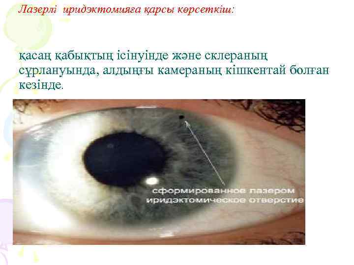 Лазерлі иридэктомияға қарсы көрсеткіш: қасаң қабықтың ісінуінде және склераның сұрлануында, алдыңғы камераның кішкентай болған