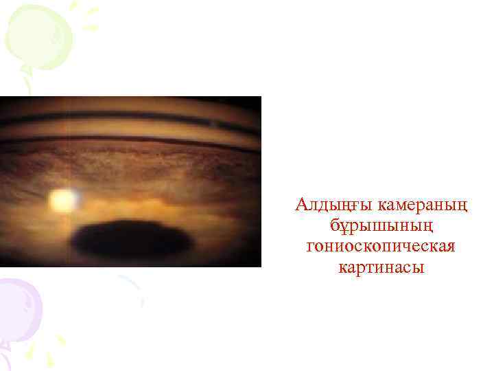 Алдыңғы камераның бұрышының гониоскопическая картинасы 