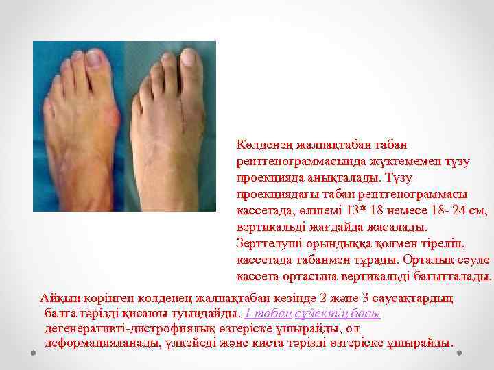 Көлденең жалпақтабан рентгенограммасында жүктемемен түзу проекцияда анықталады. Түзу проекциядағы табан рентгенограммасы кассетада, өлшемі 13*