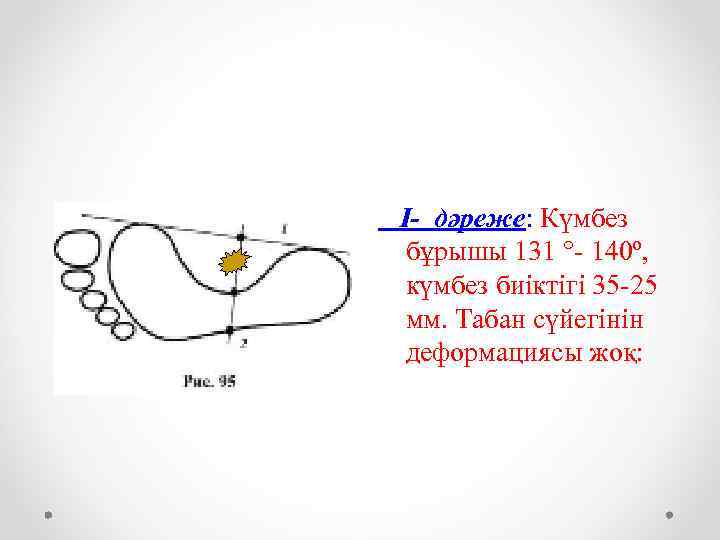 І- дәреже: Күмбез бұрышы 131 °- 140º, күмбез биіктігі 35 -25 мм. Табан сүйегінін