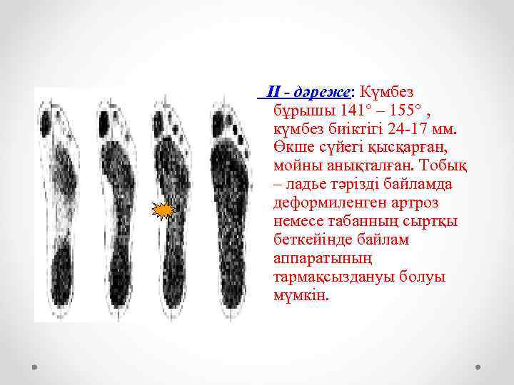 ІІ - дәреже: Күмбез бұрышы 141° – 155° , күмбез биіктігі 24 -17 мм.