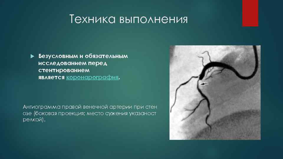 Техника выполнения Безусловным и обязательным исследованием перед стентированием является коронарография. Ангиограмма правой венечной артерии