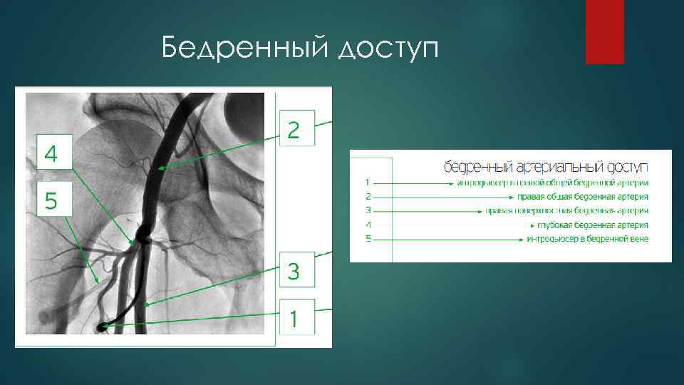 Бедренный доступ 
