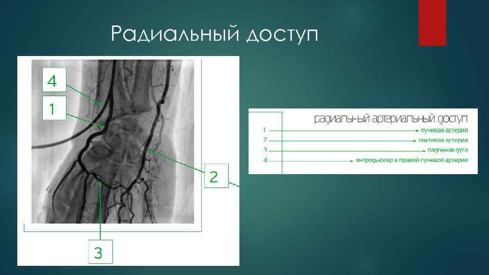 Радиальный доступ 