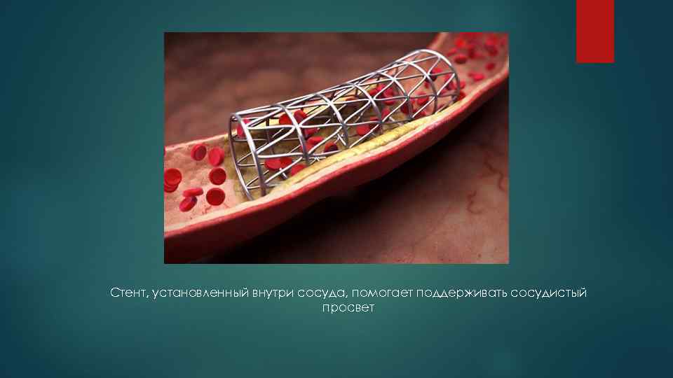 Стент, установленный внутри сосуда, помогает поддерживать сосудистый просвет 