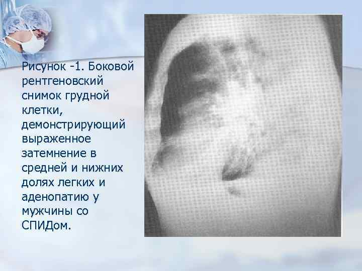 Рисунок -1. Боковой рентгеновский снимок грудной клетки, демонстрирующий выраженное затемнение в средней и нижних